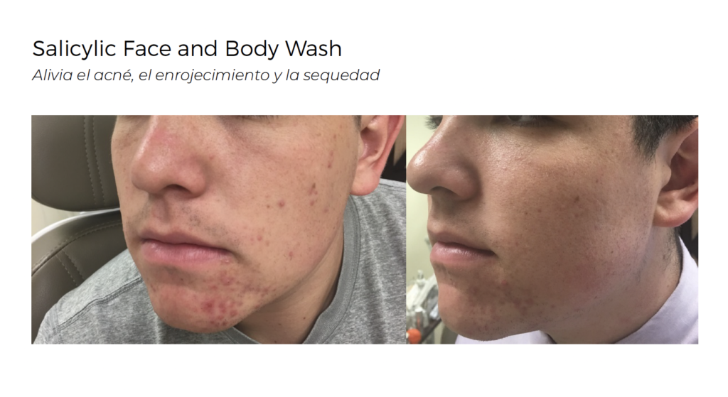 Salicylic Face and Body Wash Para pieles con hiperpigmentación, grasas o propensas al acné Limpiador microexfoliante con ácido salicílico al 2 %, a un pH bajo que mejorará la eliminación de las células muertas. Destapa los poros, nutre y previene el acné, y mejora la luminosidad y la pigmentación. Adecuado para el rostro y el cuerpo. BENEFICIOS • Limpia de manera efectiva sin secar la piel. • El ácido salicílico al 2 % ayuda a combatir el acné y los signos de la edad. • Limpia los poros en profundidad. • 100 % libre de sulfatos y fragancias. • Ideal para erupciones corporales. • Calma los granos en la ingle y los que se producen después del afeitado. INGREDIENTES DESTACADOS Ácido salicílico: derivado de la corteza de los abedules y conocido como ácido beta hidroxi, este ingrediente altamente efectivo trabaja al despegar la piel muerta de los poros y la superficie. Es reconocido por su poder para penetrar los poros y disolver la grasa y la suciedad. Este limpiador usa la máxima fuerza permitida para el uso de venta libre. Aceite de coco extra virgen al 1 %: mantiene la piel humectada y suave, mientras que sus propiedades exfoliantes ayudan a limpiar los poros sin irritar la piel. ¡CONSEJO! Deje sobre la piel durante 20 minutos para realizar una mini exfoliación.